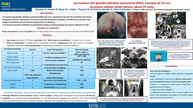 Les tumeurs des glandes salivaires accessoires GSA à propos de 25