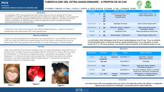 469_younes_hussein_P019-Tuberculose-ORL-extra-ganglionnaire-a-propos-de-08-cas