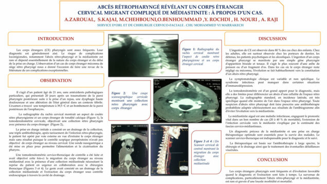 471_zaroual_atmane_P021-Abces-retropharynge-revelant-un-corps-etranger-migrant-complique-de-mediastinite-a-propos-dun-cas