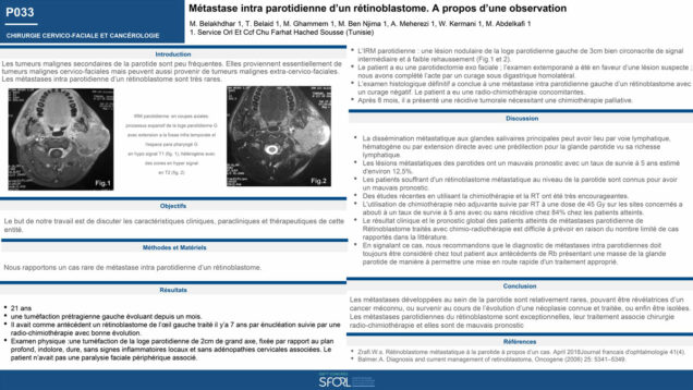 483_Belaid_Takwa_P033-Metastase-intra-parotidienne-dun-retinoblastome