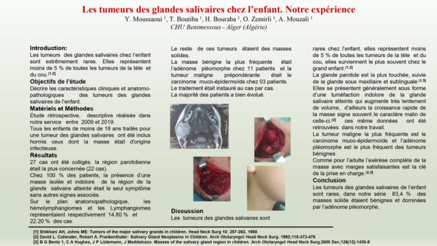 485_MOUSSAOUI_Yacine_P036-Les-tumeurs-des-glandes-salivaires-chez-lenfant