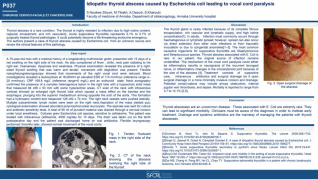 486_ZITOUNI_SOUAD_P037-Abces-thyroidien-idiopathique-provoque-par-Escherichia-coli-entrainant-une-paralysie-des-cordes-vocales