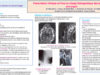 497_houas_jihene_P048-Presentation-clinique-et-Prise-en-charge-therapeutique-des-abces-retro-pharynges