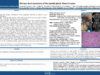 498_Chaabouni_Mohamed-Amin_P049-Salivary-duct-carcinoma-of-the-parotid-gland-About-3-cases