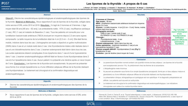 506_KHARRAT_INES_P057-Les-lipomes-de-la-thyroide-A-propos-de-6-cas