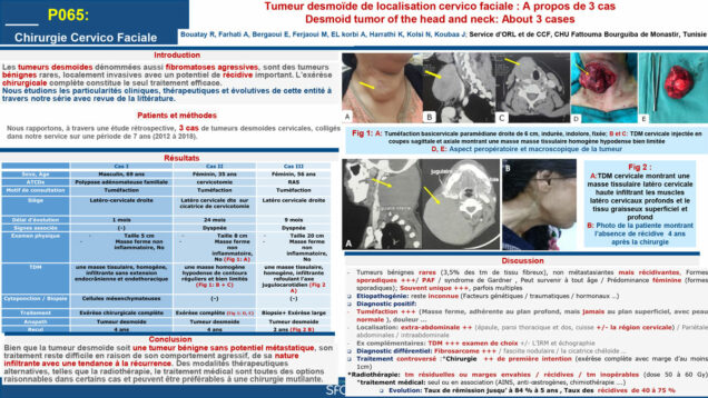 514_Bouatay_rachida_P065-La-tumeur-desmoide-de-localisation-cervico-faciale-A-propos-de-3-cas