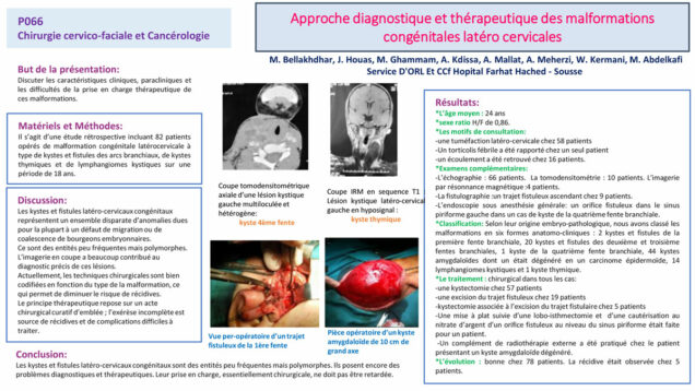 515_houas_jihene_P066-Approche-diagnostique-et-therapeutique-des-malformations-congenitales-latero-cervicales