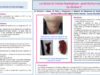 519_houas_jihene_P070-Les-kystes-du-tractus-thyreoglosse-quels-facteurs-predictifs-de-recidive