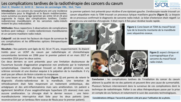 522_JBALI_Souheil_P073-Les-complications-tardives-de-la-radiotherapie-des-cancers-du-cavum