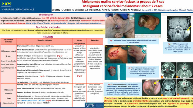 528_Bouatay_rachida_P079-Melanomes-malins-cervico-faciaux-a-propos-de-7-cas