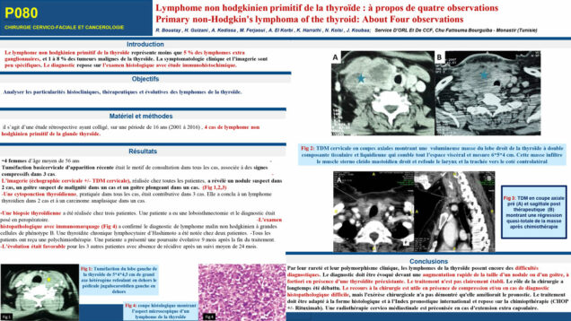 529_Bouatay_rachida_P080-Lymphome-non-hodgkinien-primitif-de-la-thyroide-a-propos-de-quatre-observations