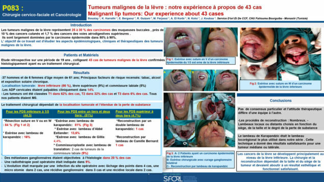 532_Bouatay_rachida_P083-Tumeurs-malignes-de-la-levre-notre-experience-a-propos-de-43-cas