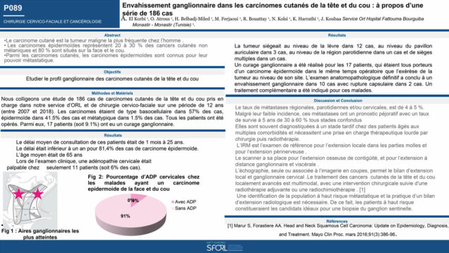 538_KHALED_Harrathi_P089-Envahissement-ganglionnaire-dans-les-carcinomes-cutanes-de-la-tete-et-du-cou-a-propos-dune-serie-de-186-cas