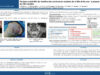 539_KHALED_Harrathi_P090-Facteurs-predictifs-de-recidive-des-carcinomes-cutanes-de-la-tete-et-du-cou-a-propos-dune-serie-de-186-malades