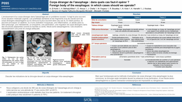 544_KHALED_Harrathi_P095-Corps-etranger-de-loesophage-dans-quels-cas-faut-il-operer