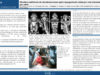 545_CHEBIB_Emilien_P096-Recidive-multifocale-de-chondrosarcome-apres-laryngectomie-totale-par-voie-transorale-assistee-par-robot