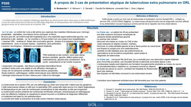 548_BOUKERCHE_AMEL_P099-A-propos-de-3-cas-de-presentation-atypique-de-tuberculose-extra-pulmonaire-en-ORL