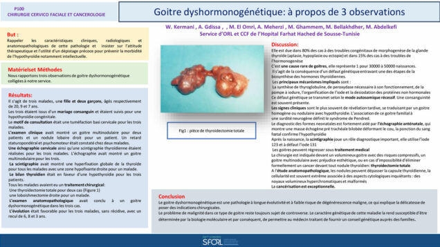 549_El-omri_Malika_P100-Goitre-dyshormonogenetique-A-propos-de-trois-observations