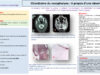550_El-omri_Malika_P101-Chondrome-du-nasopharynx-A-propos-dune-observation