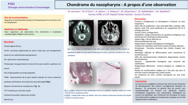 550_El-omri_Malika_P101-Chondrome-du-nasopharynx-A-propos-dune-observation