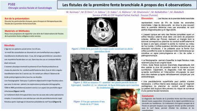 551_El-omri_Malika_P102-Les-fistules-de-la-premiere-fente-branchiale-A-propos-des-4-observations