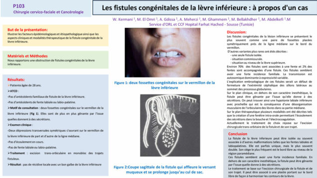 552_El-omri_Malika_P103-Les-fistules-congenitales-de-la-levre-inferieure-a-propos-dun-cas