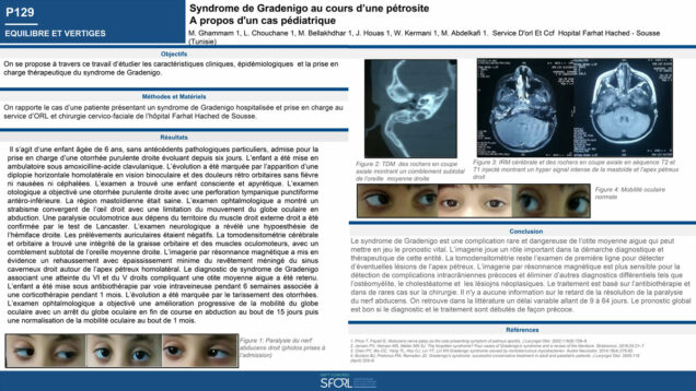 578_CHOUCHANE_Lobna_P129-Syndrome-de-Gradenigo-au-cours-dune-petrosite-a-propos-dun-cas-pediatrique