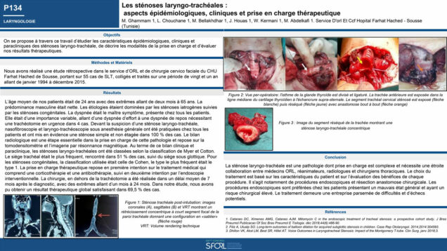 585_CHOUCHANE_Lobna_P134—Les-sténoses-laryngo-trachéales–aspects-épidéologiques,-cliniques-et-prise-en-charge-therapeutique