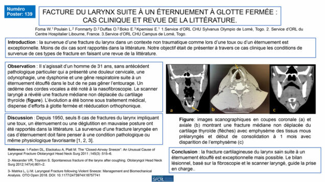 590_Foma_Winga_P139-Facture-du-larynx-suite-a-un-eternuement-a-glotte-fermee-cas-clinique-et-revue-de-la-litterature