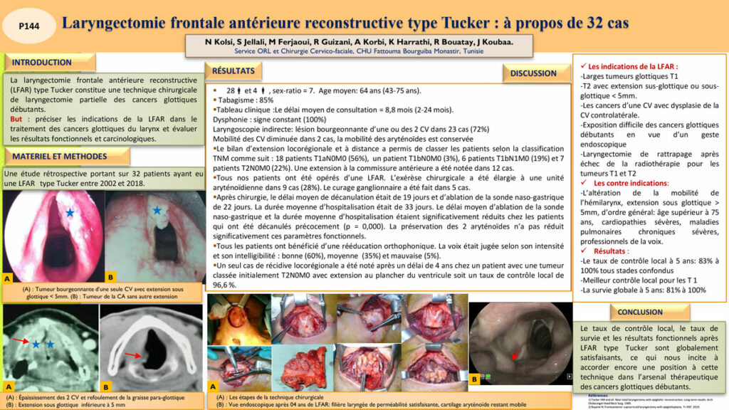 Laryngectomie Frontale Antérieure Reconstructive Type Tucker : à Propos ...