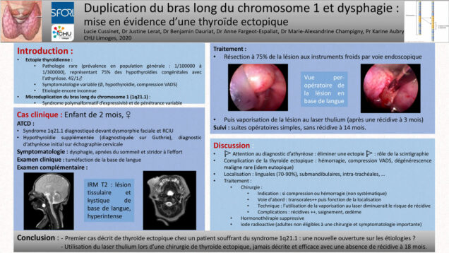 613_AUBRY_KARINE_P161-Decouverte-dune-thyroide-ectopique-dans-le-cadreune-duplication-du-bras-long-du-chromosome-1-a-propose-dun-cas