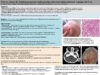 614_ROUBAUD_Jean-Christophe_P162-Prise-en-charge-de-rhabdomyosarcomes-embryonnaires-retro-auriculaires-neonataux