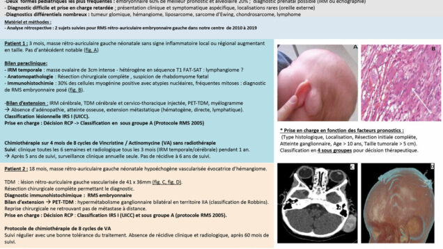 614_ROUBAUD_Jean-Christophe_P162-Prise-en-charge-de-rhabdomyosarcomes-embryonnaires-retro-auriculaires-neonataux