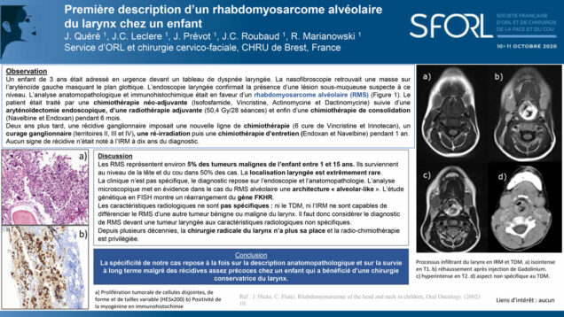 620_Quere_Julien_P168-Premiere-description-dun-rhabdomyosarcome-alveolaire-du-larynx-chez-un-enfant