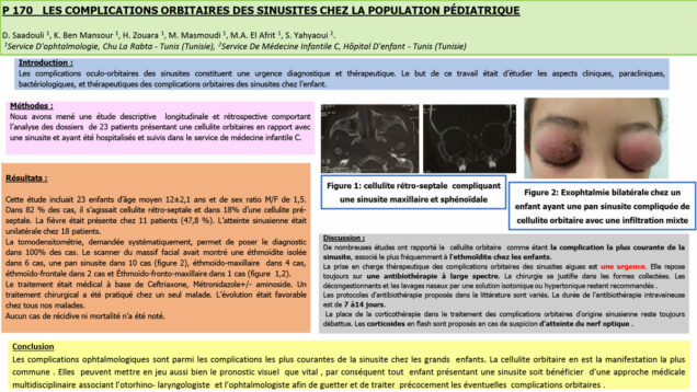622_SAADOULI_Dorsaf_P170-Les-complications-orbitaires-des-sinusites-chez-la-population-pediatrique
