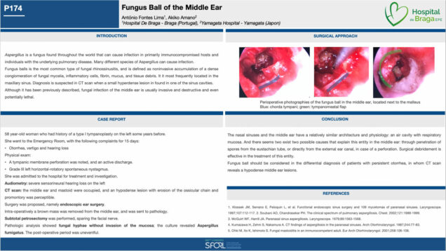 626_Fontes-Lima_Antonio_P174-Fungus-ball-of-the-middle-ear