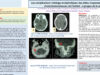 654_El-omri_Malika_P203-Les-complications-meningo-encephaliques-des-otites-moyennes-chroniques-cholesteatomateuses-de-lenfant-a-propos-de-6-cas