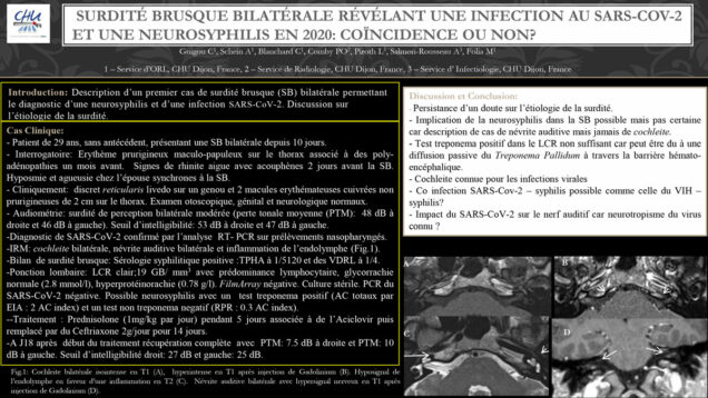 655_Guigou_Caroline_P204-Surdite-brusque-bilaterale-revelant-une-infection-au-SARS-CoV-2-et-une-neurosyphilis-en-2020-coincidence-ou-non