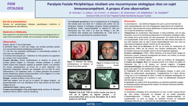 659_El-omri_Malika_P208-Paralysie-faciale-peripherique-revelant-une-mucormycose-otologique-chez-un-sujet-immunocompetent