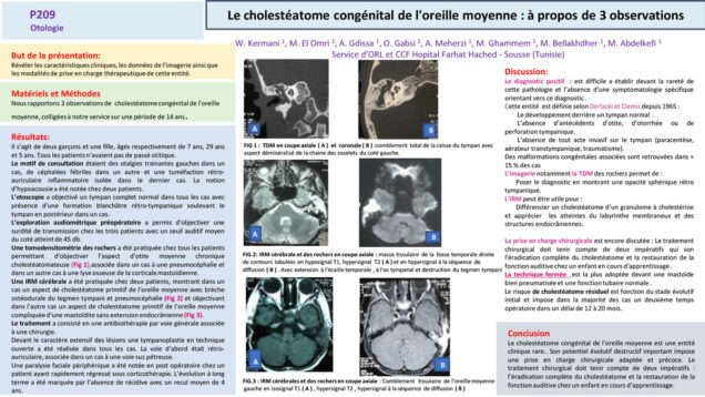660_El-omri_Malika_P209-LE-cholesteatome-congenital-de-reille-moyenne-a-propos-de-3-observations