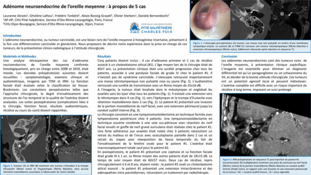 678_Alciato_Lauranne_P227-Adenome-neuroendocrine-de-loreille-moyenne-a-propos-de-5-cas