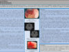 688_Kajai_Soufiyane_P236-Stenose-choanale-postradique-complication-rare-de-la-radiotherapie