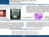 690_younes_hussein_P238-Adenome-pleiomorphe-du-septum-nasal-a-propos-dun-cas