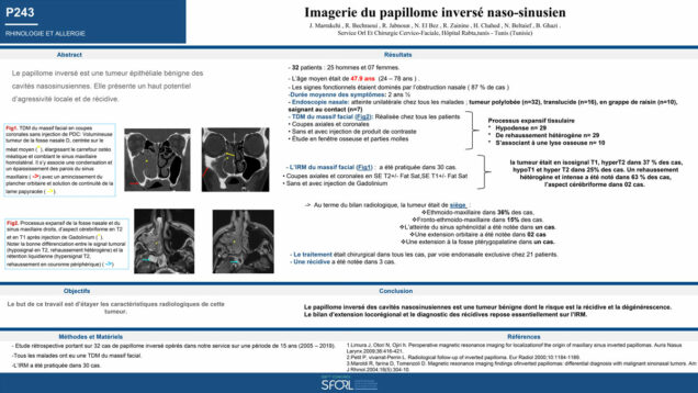 695_JABNOUN_Ramzi_P243-Imagerie-du-papillome-inverse-naso-sinusien