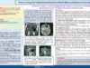 706_Meherzi_Abir_P254-Prise-en-charge-de-lesthesioneuroblastome-olfactif-Notre-experience-et-revue-de-la-litterature