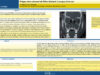 707_Masmoudi_mohamed_P255-Polype-antro-choanal-de-Kilian-bilateral-a-propos-dun-cas