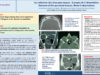 708_Bouatay_rachida_P256-Les-osteomes-des-sinus-paranasaux-A-propos-de-5-observations