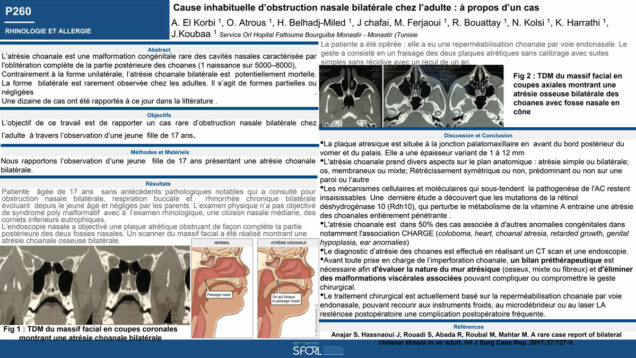 712_KHALED_Harrathi_P260-Cause-inhabituelle-dobstruction-nasale-bilaterale-chez-ladulte-a-propos-dun-cas