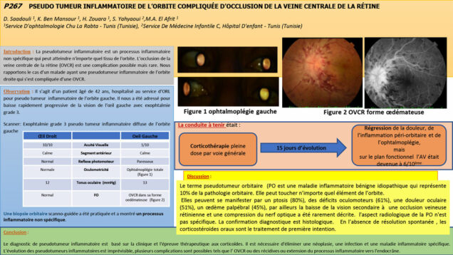 718_SAADOULI_Dorsaf_P267-Pseudo-tumeur-inflammatoire-de-lorbite-compliquee-docclusion-de-la-veine-centrale-de-la-retine