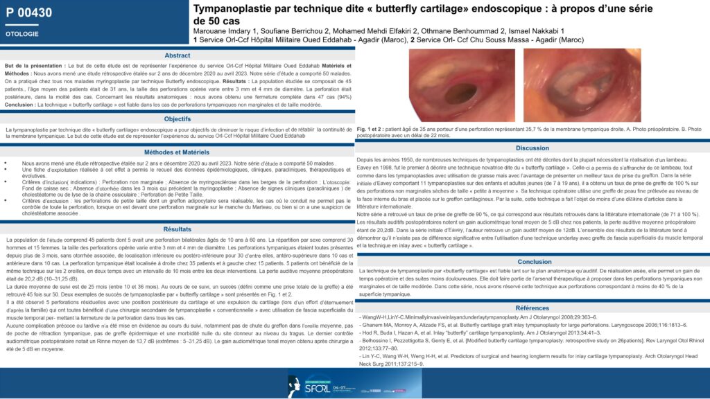 Réparation de perforation de la membrane tympanique